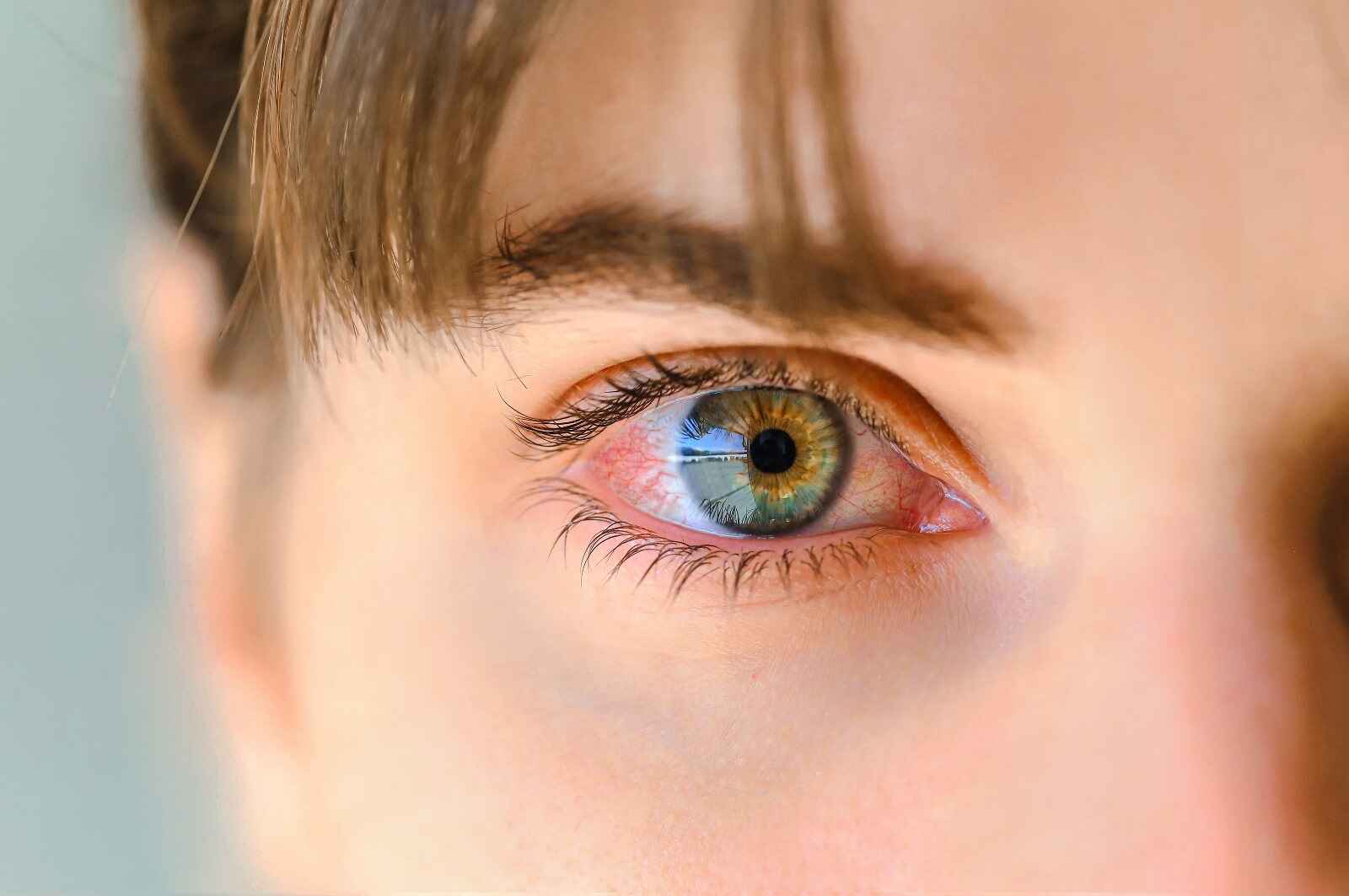 Common symptoms of red eyes include eye irritation, bloodshot eyes, and dry eyes.